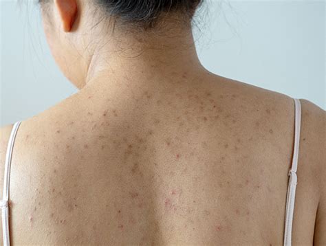 What Are All These Splotches On My Skin — Ssdp