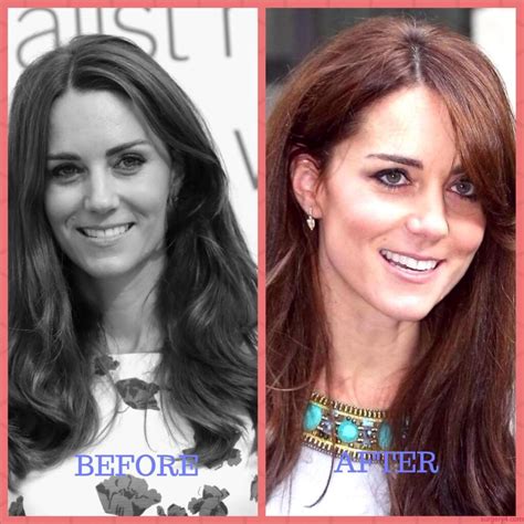 Kate Middleton Plastic Surgery Photos [before And After] Surgery4