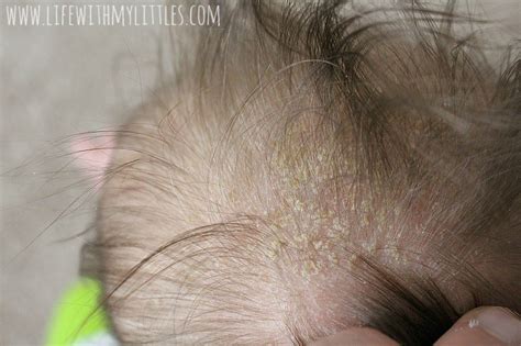 How To Get Rid Of Cradle Cap Life With My Littles