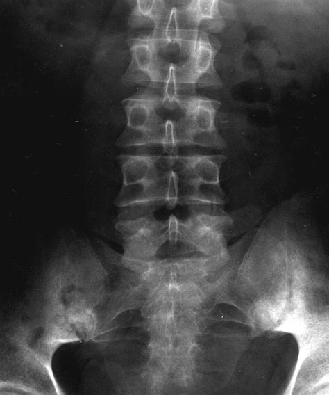 Diagnosis And Management Of Ankylosing Spondylitis The Bmj