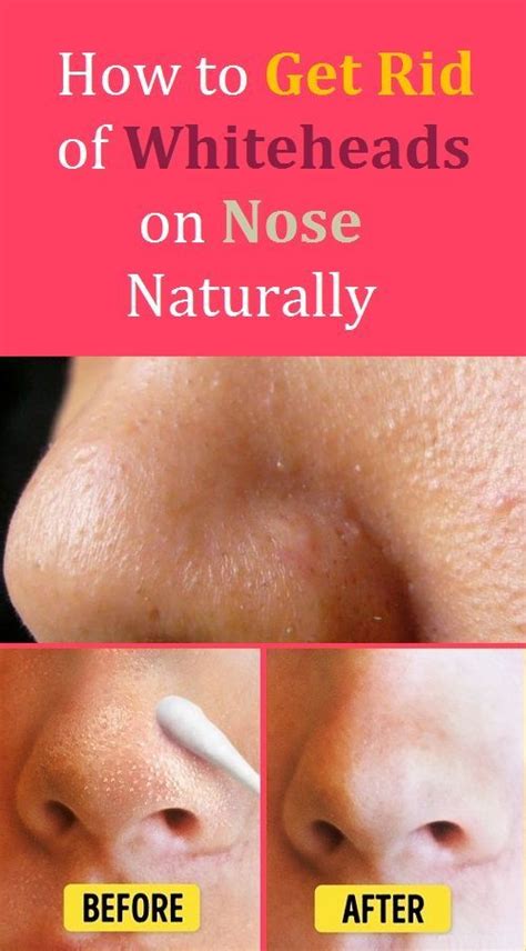 How To Get Rid Of Whiteheads On Nose Naturally Whiteheads Remove