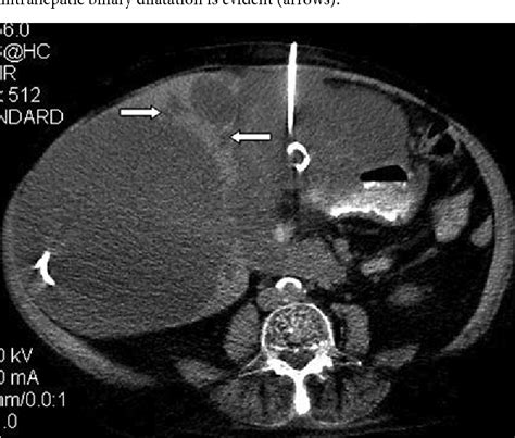 Figure 1 From Obstructive Jaundice In Polycystic Liver Disease Related
