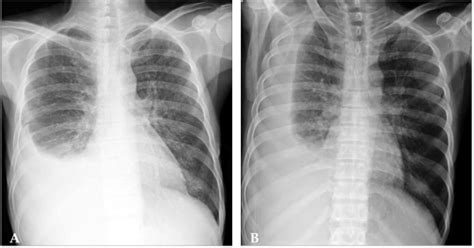 Chest X Ray A Chest Pa B Chest Right Decubitus View Right Side
