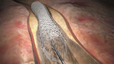 What Happens During A Coronary Angioplasty Latest News Videos Fox News