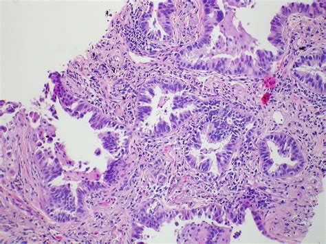 Adenocarcinoma Arising In Bronchiolar Metaplasia Case 274 Flickr