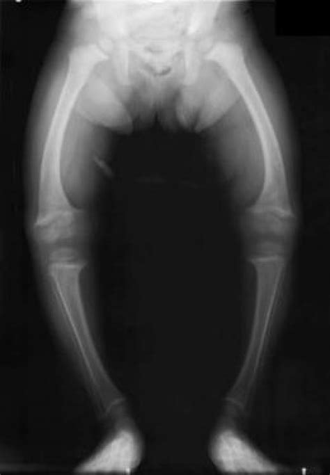 Pictures Of A Vitamin Deficiency Disease Known As Rickets
