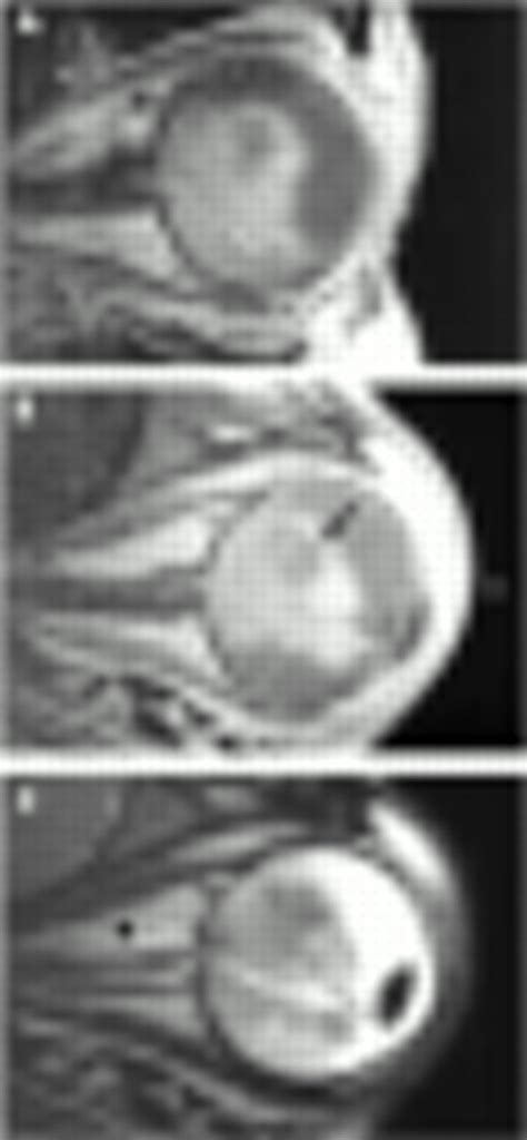 High Resolution Magnetic Resonance Imaging Of Retinoblastoma British