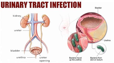10 Tips To Avoid Urinary Tract Infections Natura Advantage Health And Fitness Tips