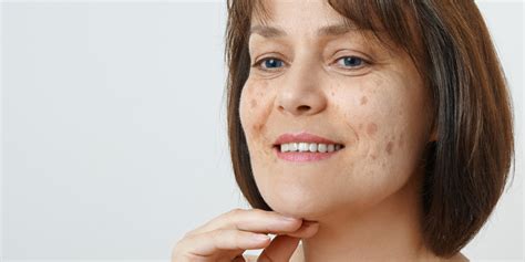How To Remove Age Spots Treatments And Cost