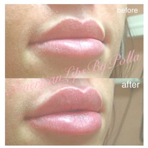 24 Best Lips Images On Pinterest Lip Fillers Fuller