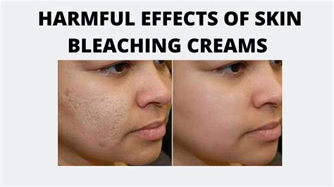Harmful Effects Of Skin Bleaching Creams To Your Health Quality Details
