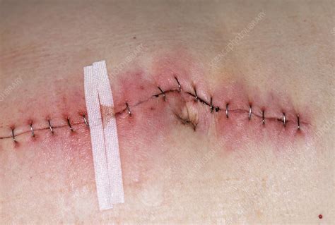 Surgical Wound Infection