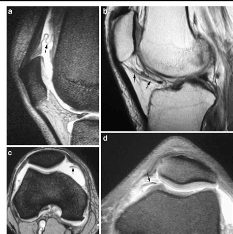 Synovial Recesses Of The Knee Mr Imaging Review Of Anatomical And