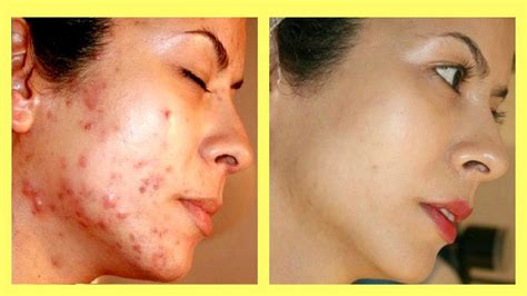 Howto How To Get Rid Of Acne Marks On Face