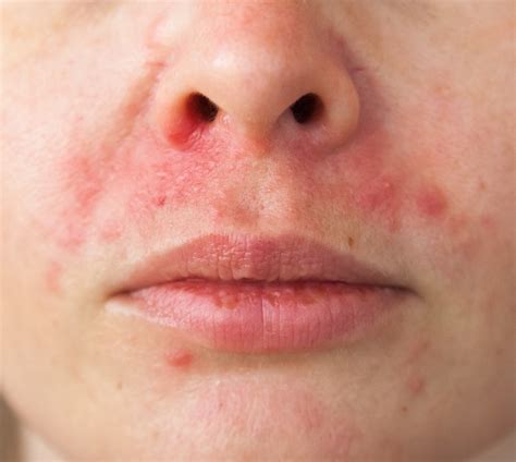 What Is Perioral Dermatitis Find Out From The Dermatologist