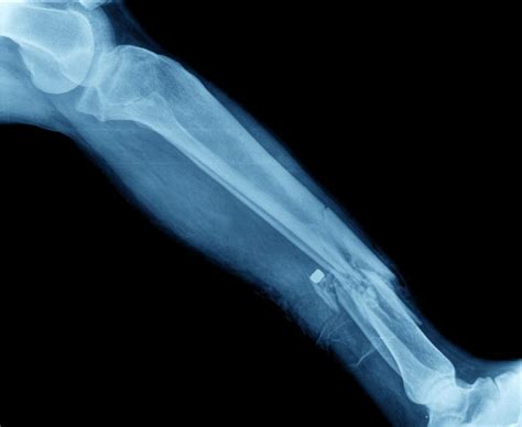What Are Compound Fractures Facty Health