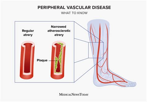 Peripheral Vascular Disease Causes Symptoms And Treatment