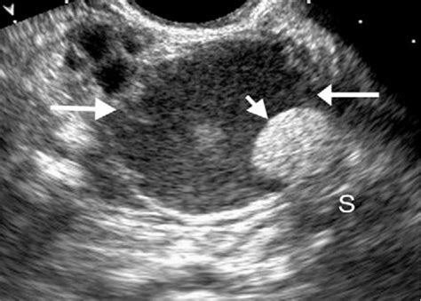 Mature Cystic Teratoma Transvaginal Us Scan Shows A Complex Ovarian