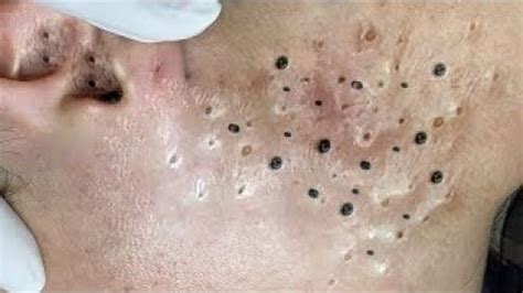 Popping Huge Blackheads And Giant Pimples Best Pimple Popping Videos