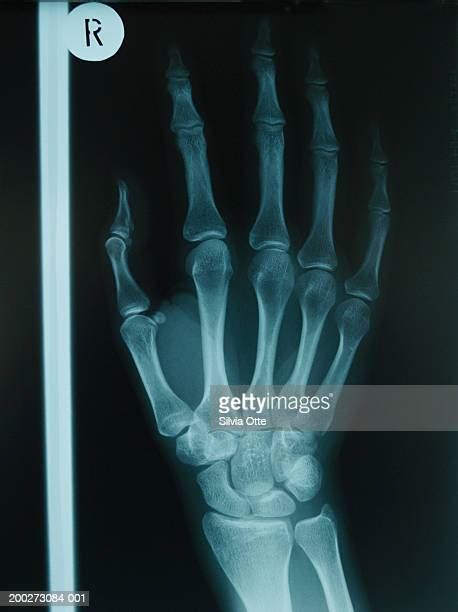 Right Hand X Ray Photos And Premium High Res Pictures Getty Images