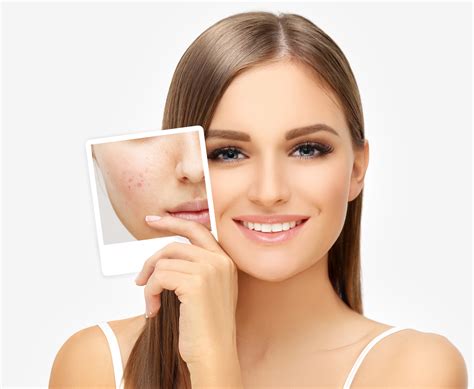 Acne When Is It Time To See A Dermatologist Vanguard Skin Specialists
