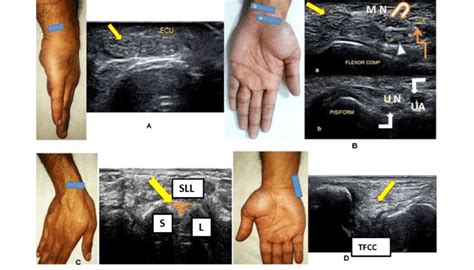 Wrist tendonitis is the inflammation of one or more tendons in the wrist. Ultrasound of the dorsal aspect of the wrist demonstrating compartment... | Download Scientific ...