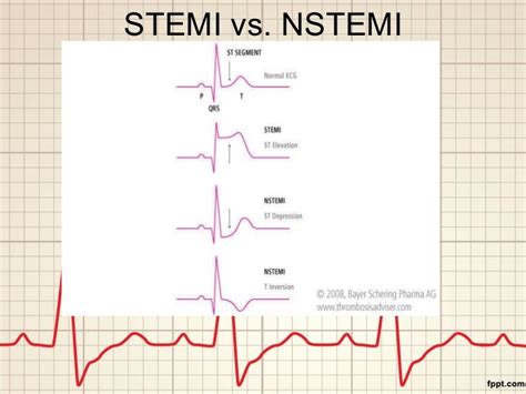 Jetzt klicken & optimal auf die prüfung vorbereiten! stemi vs nstemi nursing - Google Search | school ...