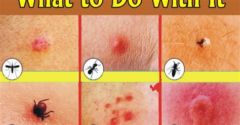 How To Identify A Bug Bite And What To Do With It ~ Webvb