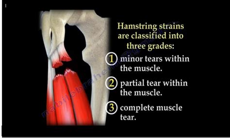 Hamstring Injuries —