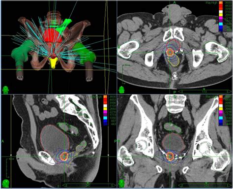 Frontiers Stereotactic Re Irradiation For Local Recurrence In The Prostatic Bed After