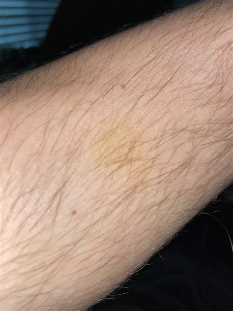 Have A Distinct Yellow Spot On My Forearm What Does This Indicate Am