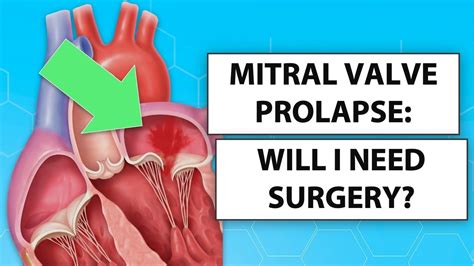 Mitral Valve Prolapse Will I Need Heart Surgery Youtube