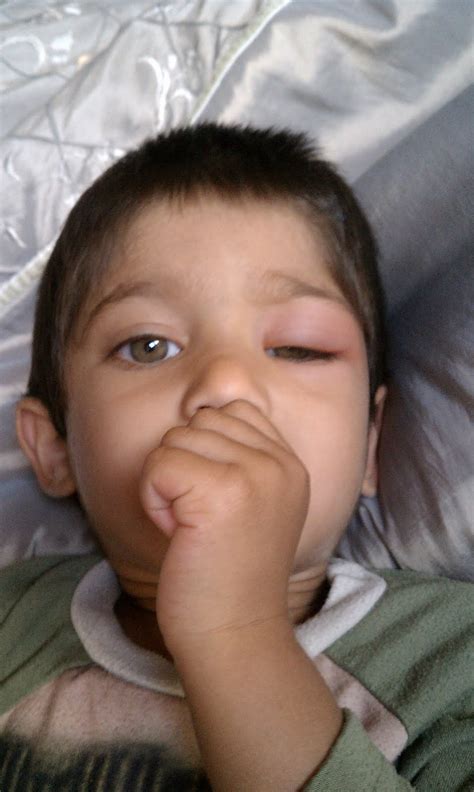 Allergy Trigger Allergic Reaction Swollen Eyes Child