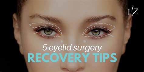 5 Eyelid Surgery Recovery Tips — Hz Plastic Surgery