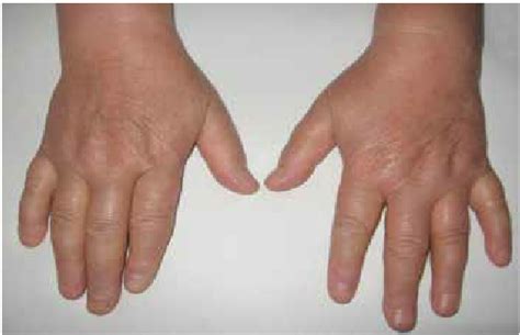 Patients Hands With Swollen And Tender Joints Urticaria 9 Erythema