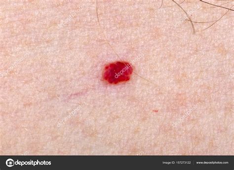 Cherry Angioma On Human Skin Stock Photo By ©obencem 157273122
