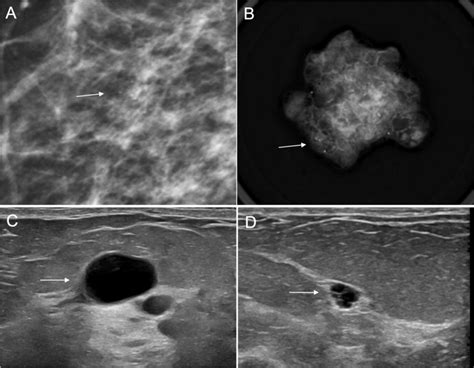 Fibrocystic Change A 62 Year Old Woman With Grouped Amorphous