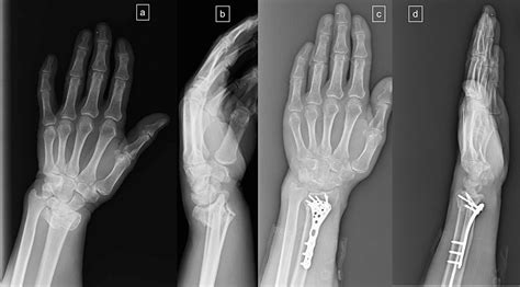 Cureus Clinical Results Of Distal Radius Intraarticular Comminuted