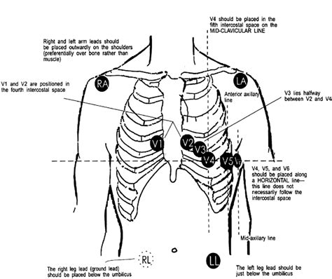 Standard 12 Lead Ecg Electrode Placement 27 Download