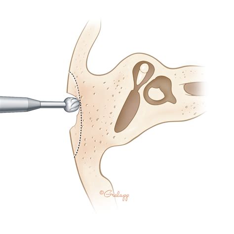 Mastoidectomy Oto Surgery Atlas