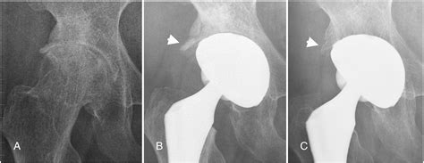 The Fate Of Osteophytes In The Superolateral Region Of The Acetabulum