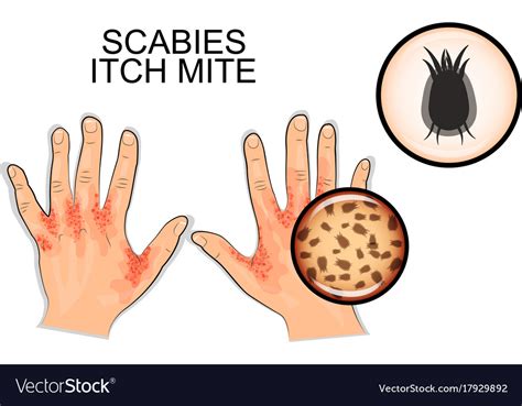 Infection Scabies Itch Mite Royalty Free Vector Image
