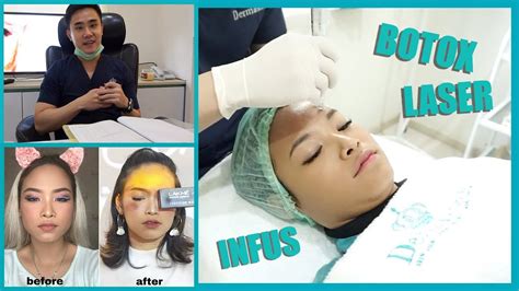 Botox Dan Treatment Di Dermaster Harganya Amyra Irzanti Youtube