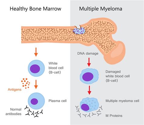 Myeloma Multiple Overview Causes Symptoms Treatment