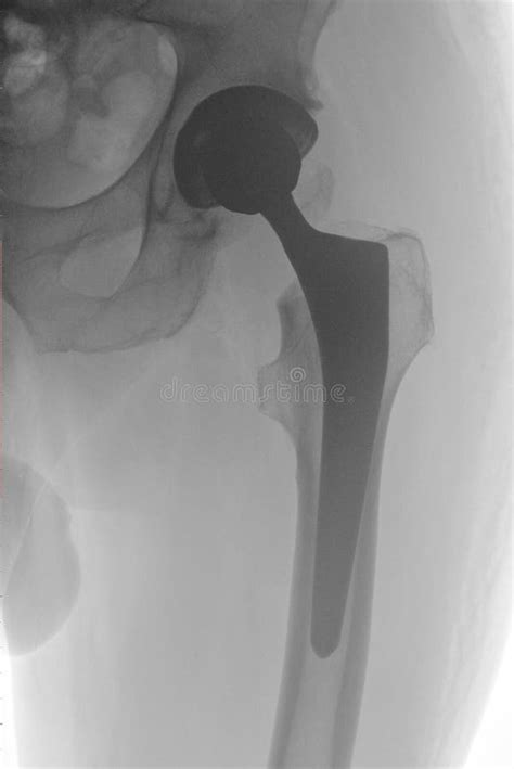 Prosthetic Hip Replacement Stock Photo Image Of Fake 23397160