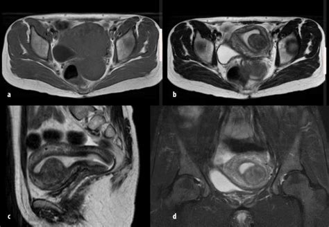 Classic Mri Features Of Submucosal Uterine Fibroids A T Wi Axial