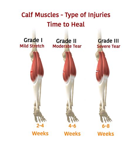 Do You Keep Pulling Your Calf Learn More About Calf Muscle Injuries In Soccer Players