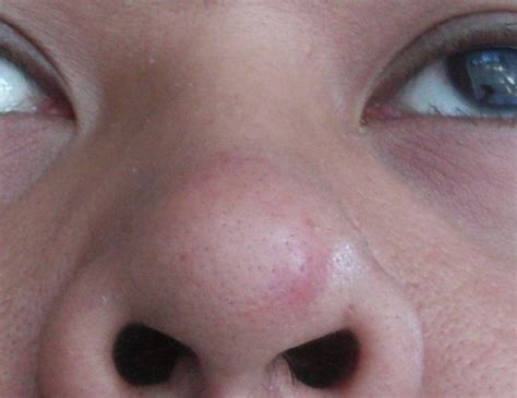 Fibrous Papule Of The Nose Pictures Photos