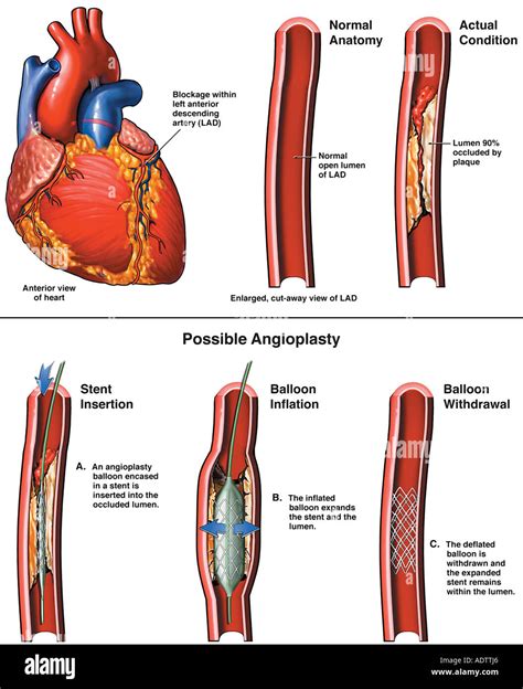 Estenosis De La Arteria Coronaria Con Angioplastia Fotografía De Stock