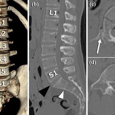 Ct Images Of Lumbarisation And Unilateral Lumbar Rib A Open I My Xxx